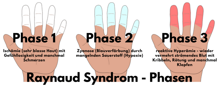Raynaud Syndrom